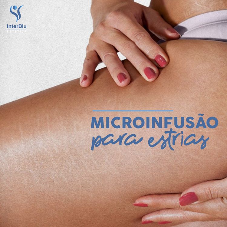 Microinfusão para Estrias